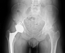 Image of Hip X-Ray